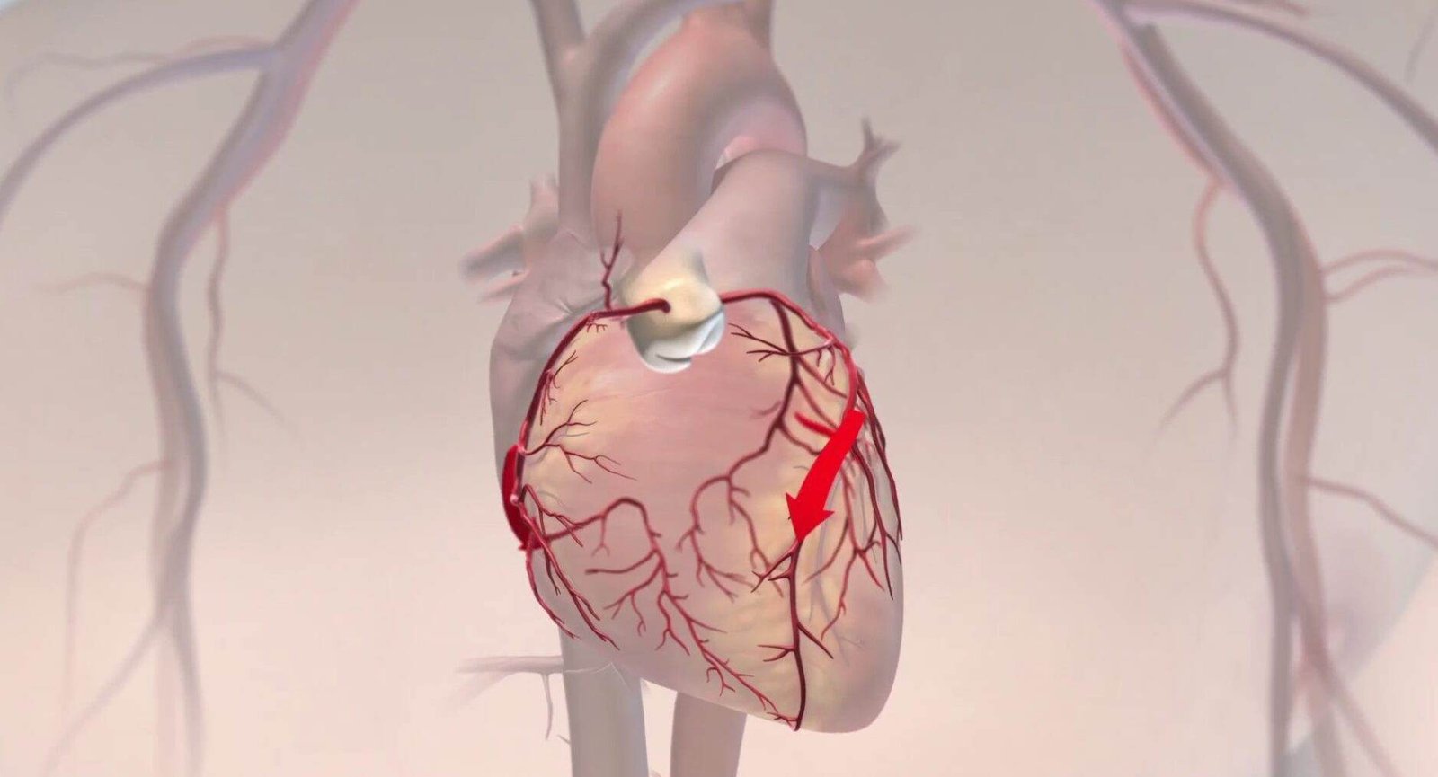 Kalp Damarları Genişlemesi